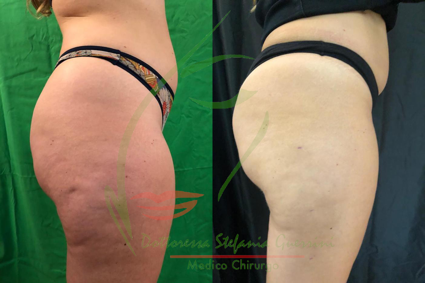 Liposcultura 051120 3