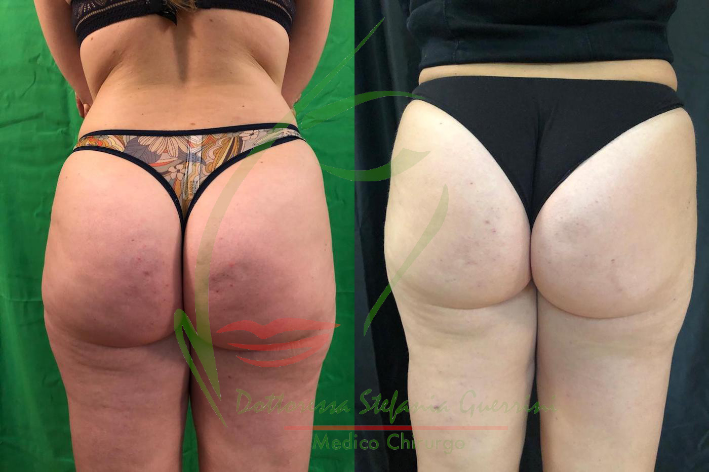 Liposcultura 051120 4