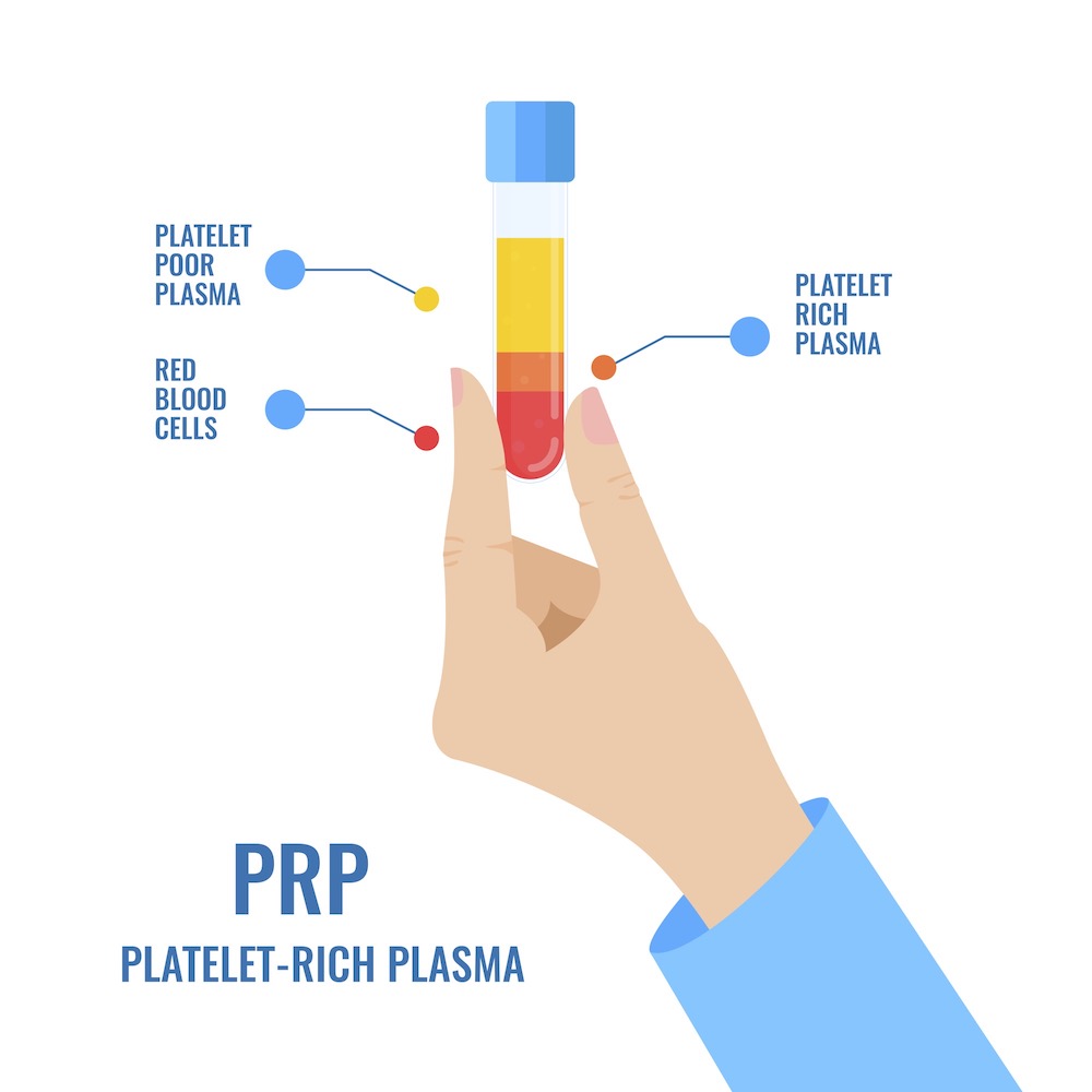 Plasma ricco di piastrine